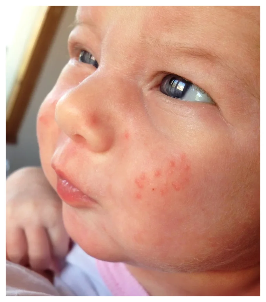 Caucasian baby with red baby acne spots clustered on her cheeks. The skin between the spots is clear.