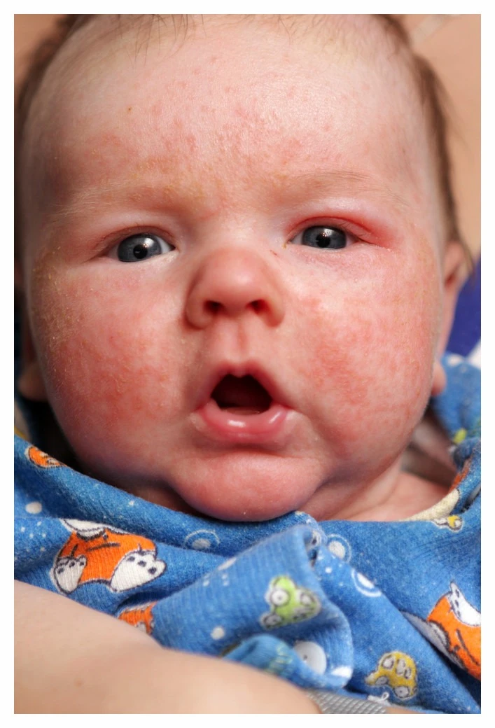 Bébé garçon dont le visage est recouvert d'un eczéma de colère
