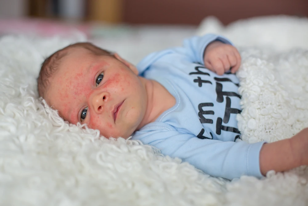 Bébé avec un eczéma en colère sur le visage