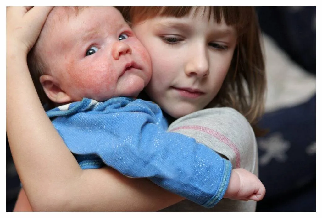 Ein junges Mädchen kuschelt sich an ihren kleinen Bruder, dessen Gesicht rot und von einem Babyekzem entzündet ist. Er schaut zum Fotografen auf, um sich zu vergewissern, dass er nicht fallen gelassen wird.