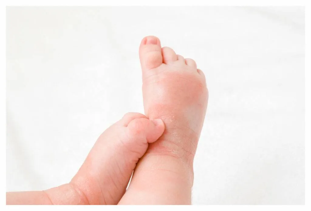 Gros plan des jambes et des pieds du bébé montrant des plaques d'eczéma et un pied grattant l'autre cheville.