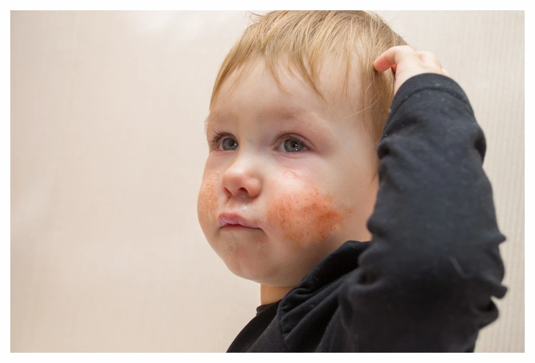 Little blonde boy with tears in his eyes and obviously infected eczema covering both cheeks. The eczema has a yellow crust and red, raw patches.